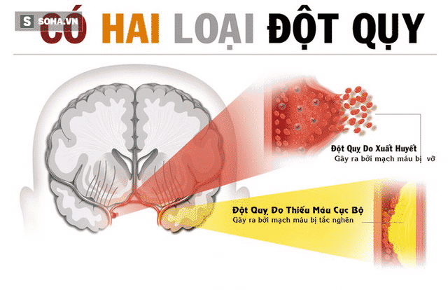 TAI BIẾN MẠCH MÁU NÃO CÓ NGUY HIỂM? 1 TAI BIẾN MẠCH MÁU NÃO CÓ NGUY HIỂM?