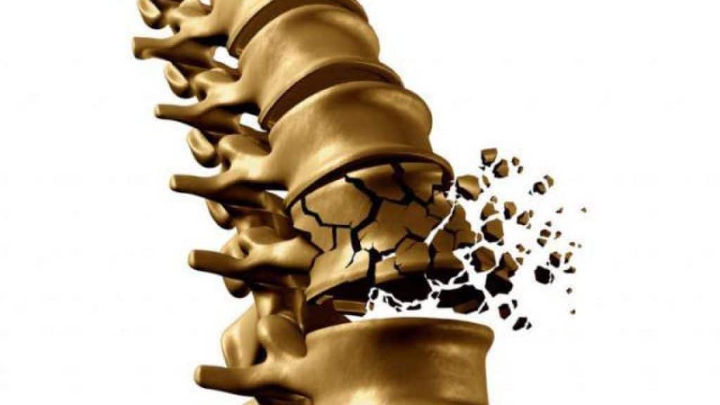 HỆ QUẢ KHI CƠ THỂ BỊ THIẾU CANXI 2 Biến chứng gẫy cơ đùi