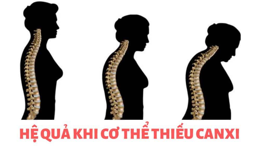 HỆ QUẢ KHI CƠ THỂ BỊ THIẾU CANXI 1 Hệ quả khi cơ thể bị thiếu canxi