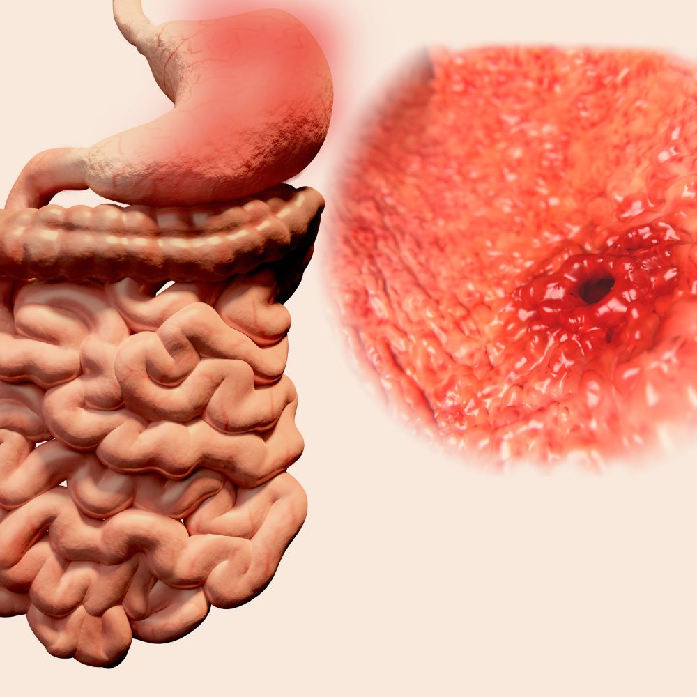 Ăn uống như thế nào cho phù hợp với người bị bệnh đau dạ dày 2 Thiết kế không tên 2 4