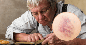 Vết bầm trên cơ thể