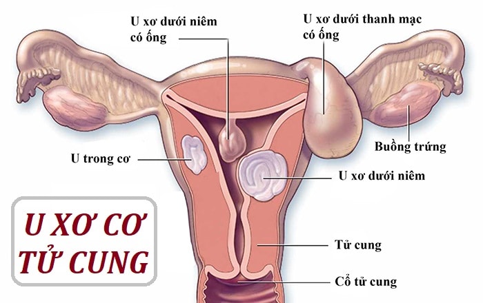 Dùng những loại thảo dược này bạn sẽ trị dứt điểm u xơ u nang 1 u xơ- u nang- các khối u trên cơ thể
