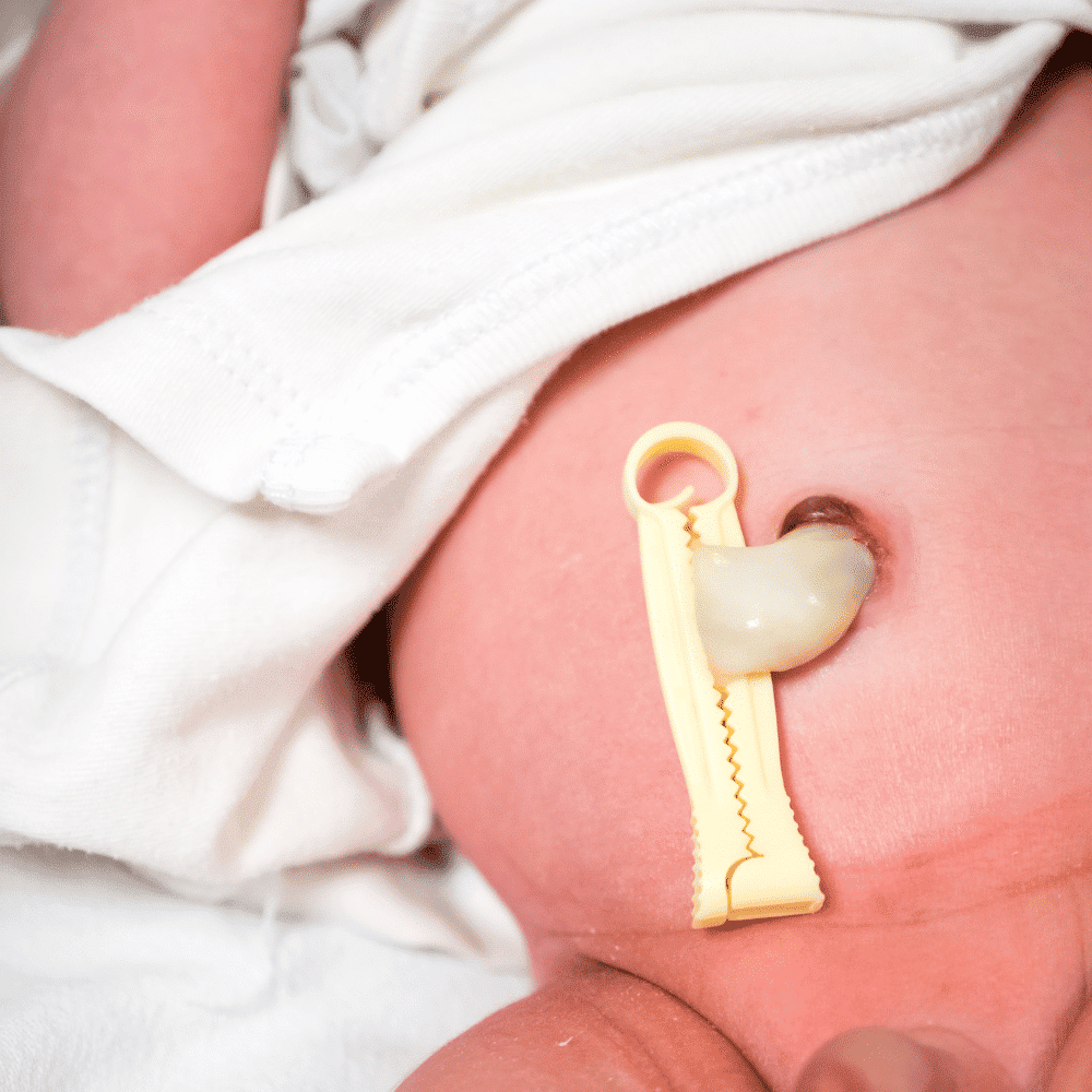 Cách chăm sóc rốn cho trẻ sơ sinh 1 Cách chăm sóc rốn cho trẻ sơ sinh