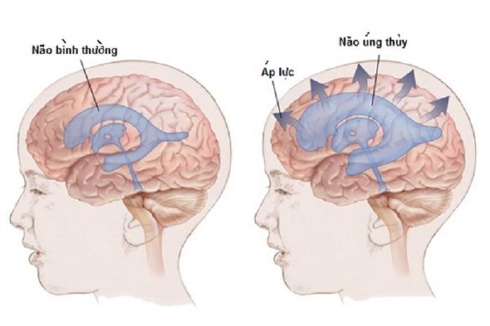 Thai Nhi Bị Não Úng Thủy: Dự Đoán, Điều Trị và Hướng Dẫn Chăm Sóc