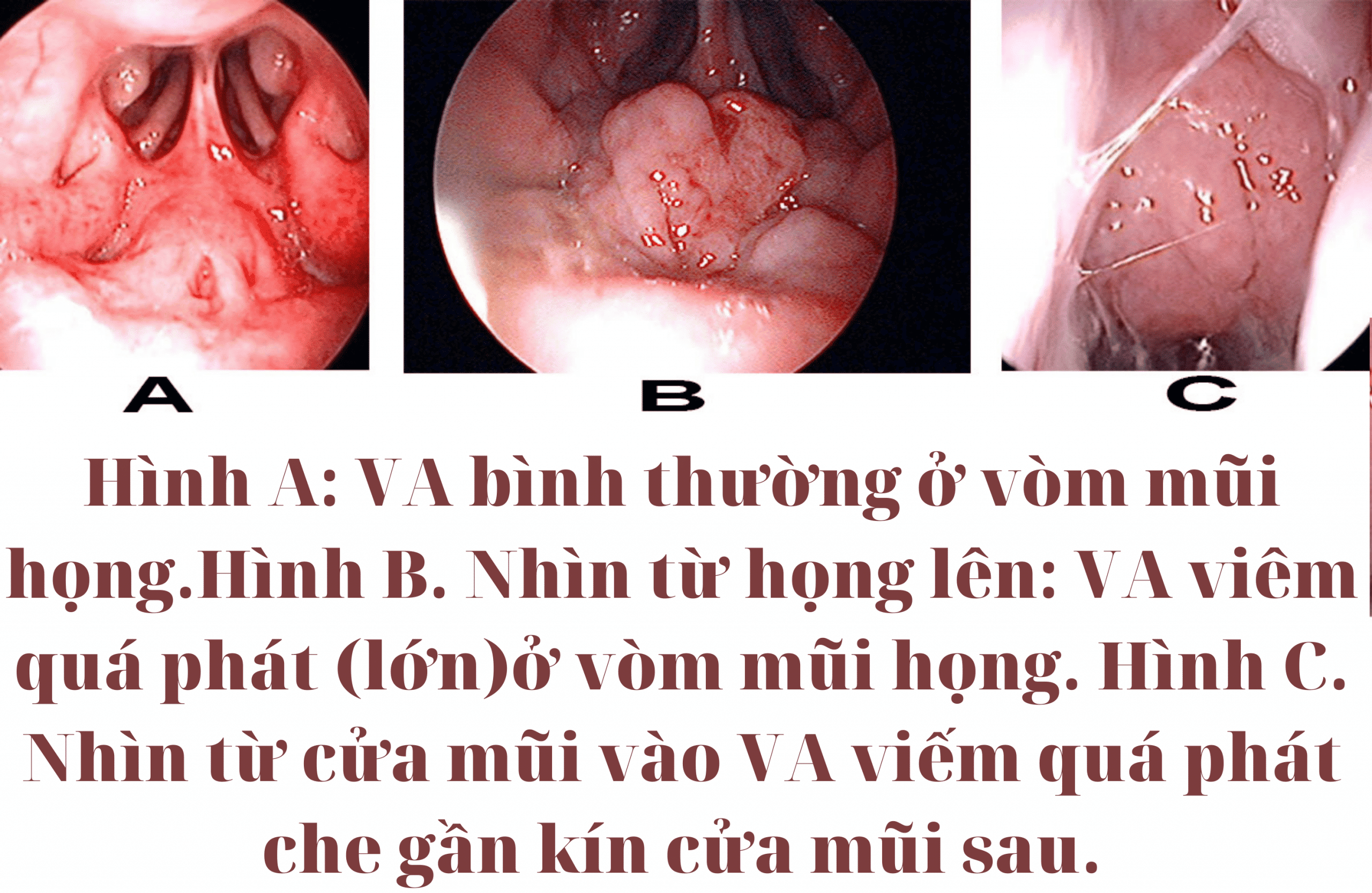 Các bệnh gây viêm đường hô hấp ở trẻ em 