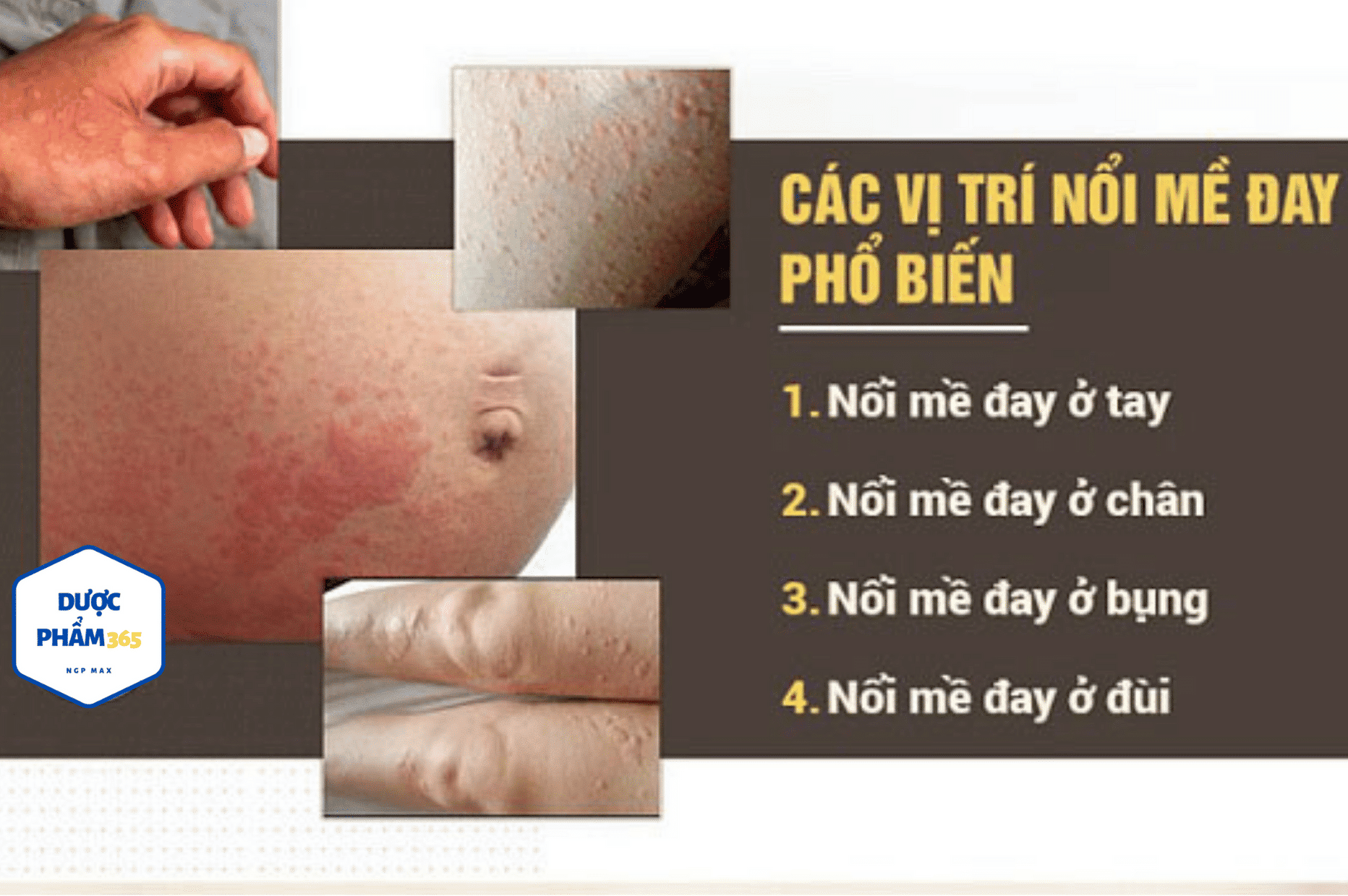 Nổi mề đay sau sinh 1 nổi mề đay sau sinh