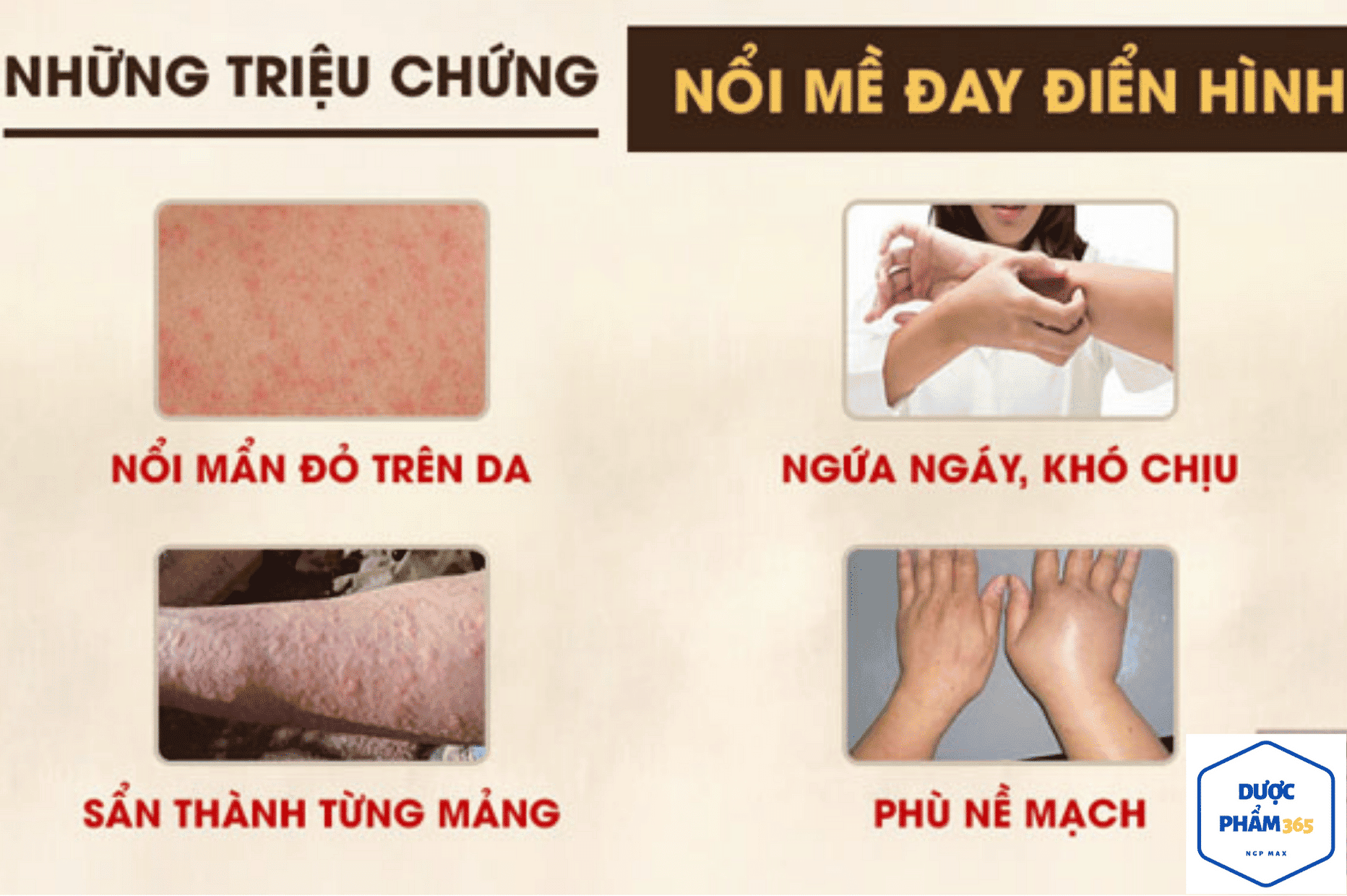 Nổi mề đay sau sinh 3 nổi mề đay sau sinh