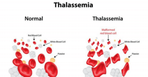 Bệnh thalassemia