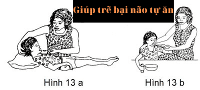 Bại não 8 bại não