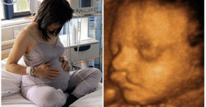 Nguyên nhân gây hở hàm ếch ở thai nhi