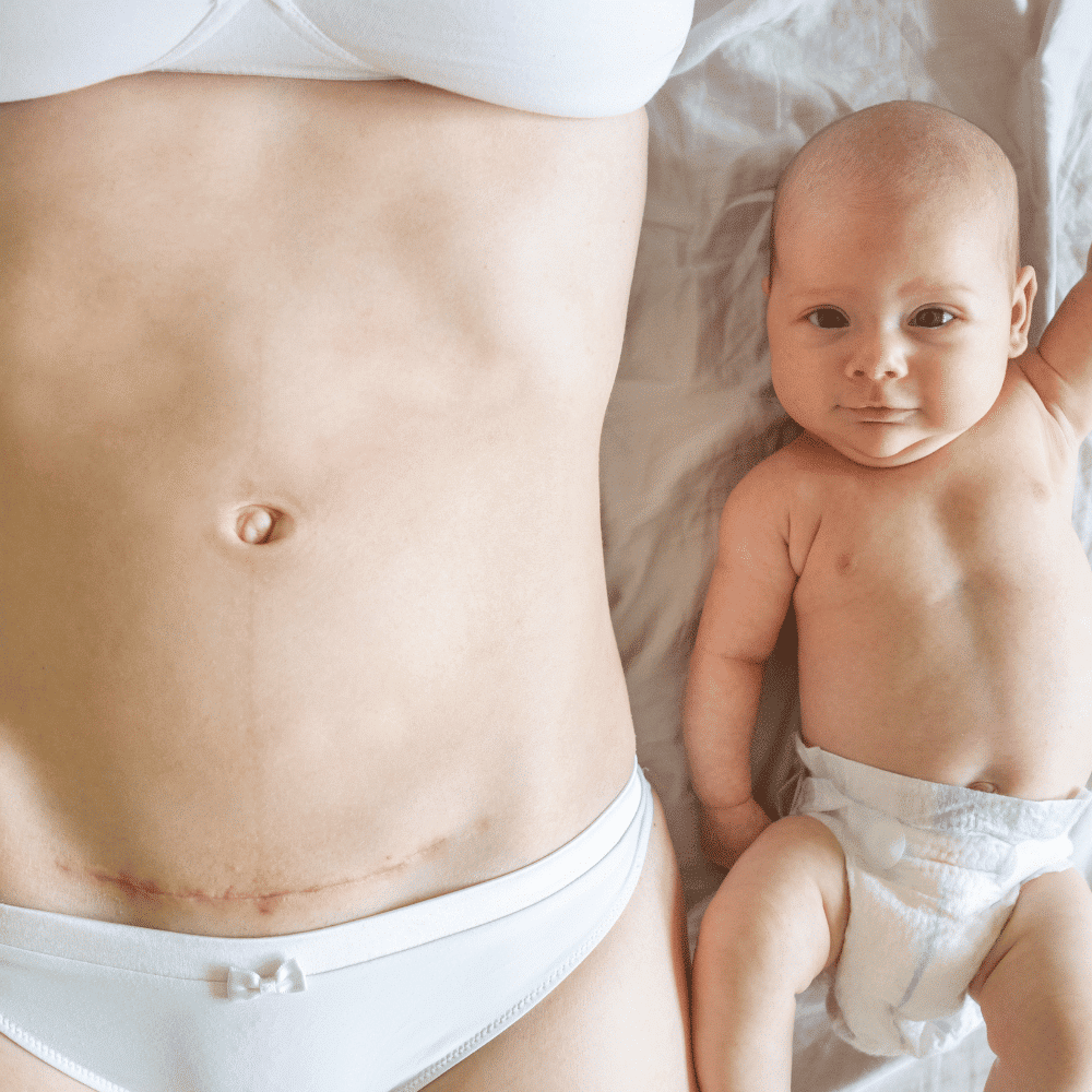 Chăm sóc hậu sản sau sinh mổ