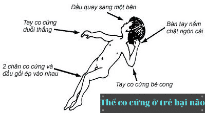 Bại não 5 bại não