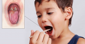 bạch hầu thanh quản