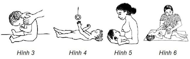 Bại não 3 bại não