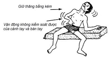 Bại não 6 bại não