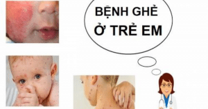 bệnh ghẻ