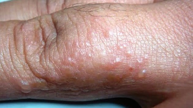 Chữa bệnh ghẻ ở trẻ em thế nào? 1 bệnh ghẻ