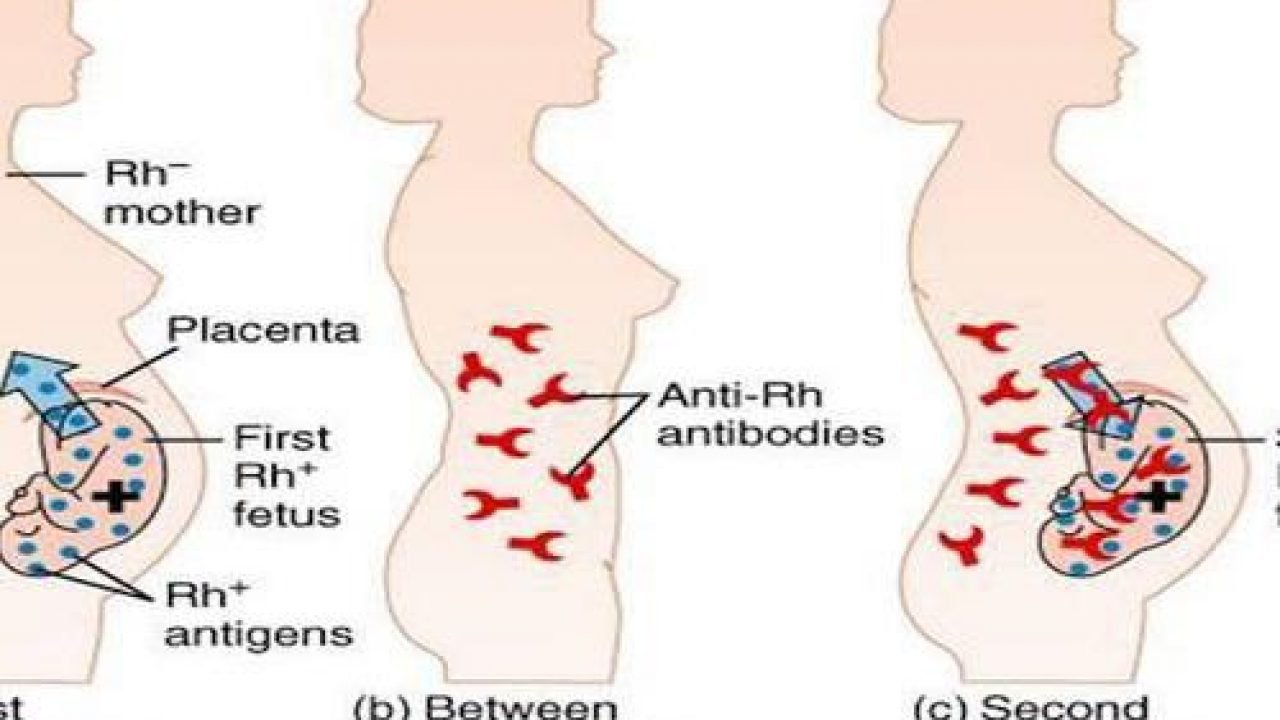 Bệnh huyết tán miễn dịch sơ sinh 1 Bệnh huyết tán miễn dịch sơ sinh