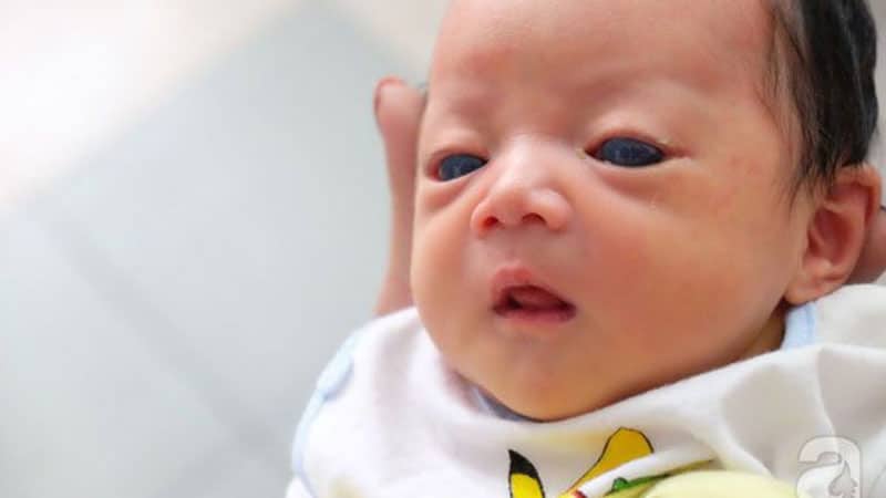 Các bệnh lý về mắt thường gặp ở trẻ em và trẻ sơ sinh 6 bệnh lý về mắt thường gặp ở trẻ em và trẻ sơ sinh