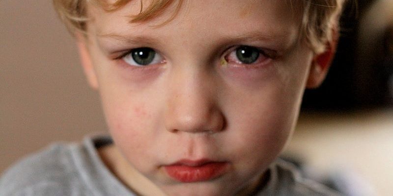 Triệu chứng và cách điều trị đau mắt đỏ ở trẻ em 2 đau mắt đỏ ở trẻ