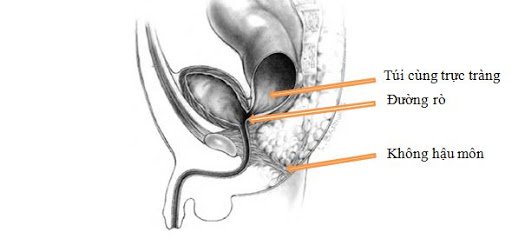 Dị tật hậu môn trực tràng
