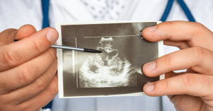 giãn não thất ở thai nhi 1