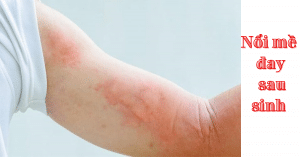 nổi mề đay sau sinh