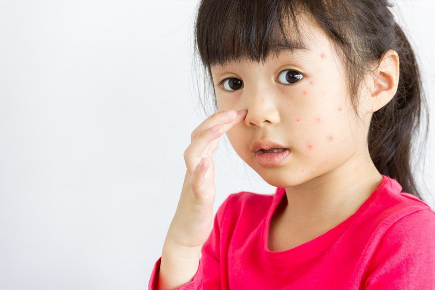 Những biểu hiện cảnh báo sốt xuất huyết ở trẻ em 3 sốt xuất huyết ở trẻ em