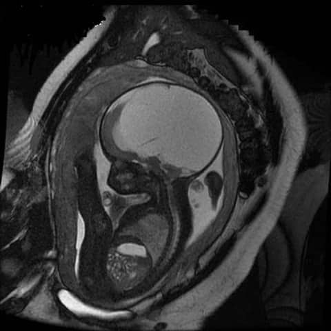 Dấu hiệu thai nhi bị não úng thủy 2 dấu hiệu thai nhi bị não úng thủy