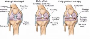 Tiến trình thoái hóa khớp