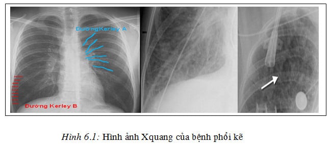 Bệnh phổi kẽ ở trẻ em