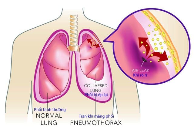 Bệnh tràn dịch màng phổi có nguy hiểm không? 1 Tràn dịch màng phổi