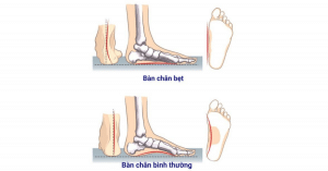 bàn chân bẹt