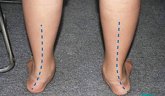 Tìm hiểu hội chứng bàn chân bẹt 1 bàn chân bẹt