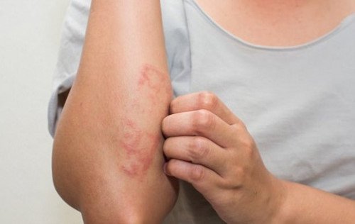 Các loại bệnh chàm: Triệu chứng và nguyên nhân 3 bệnh chàm
