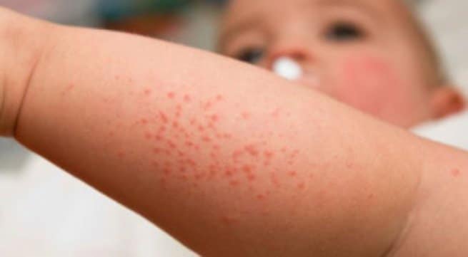 Các loại bệnh chàm: Triệu chứng và nguyên nhân 4 bệnh chàm