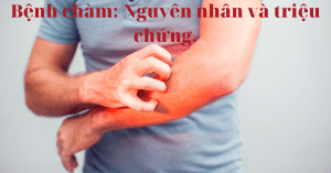 bệnh chàm