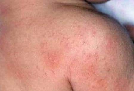Các loại bệnh chàm: Triệu chứng và nguyên nhân 2 bệnh chàm