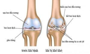 bệnh khô khớp