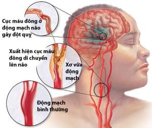 bệnh nhân bị đột nquỵ