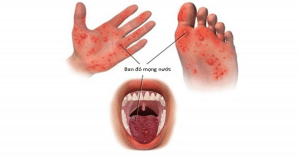 bệnh tay chân miệng ở trẻ