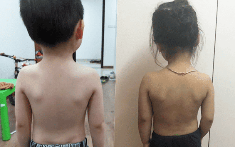 Triệu chứng cong vẹo cột sống ở trẻ em 2 cong vẹo cột sống