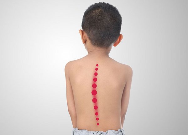 Triệu chứng cong vẹo cột sống ở trẻ em 3 cong vẹo cột sống
