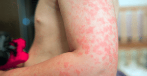 dị ứng thức ăn