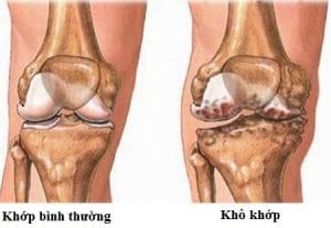 khô khớp gối