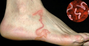 nhiễm ký sinh trùng