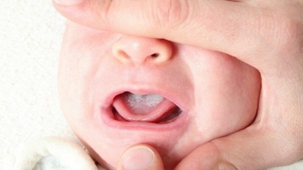 Bệnh nấm Candida ở trẻ sơ sinh 1 nấm candiada