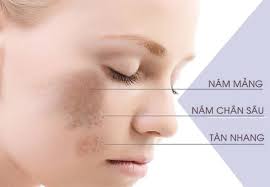 rối loạn nội tiết tố gây nám da
