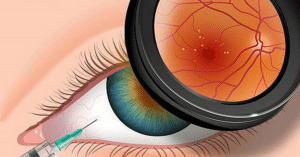 thoái hóa điểm vàng