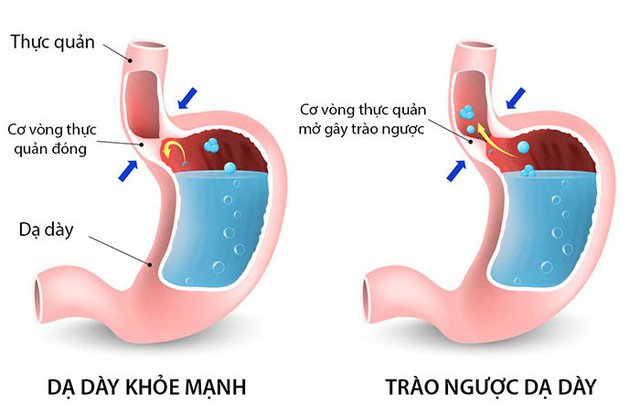 Các vấn đề thường gặp ở thực quản 4 thực quản
